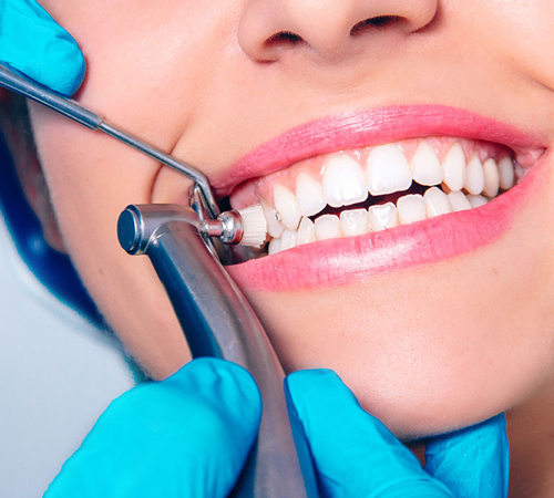 Преимущества и особенности услуг профессиональной чистки зубов