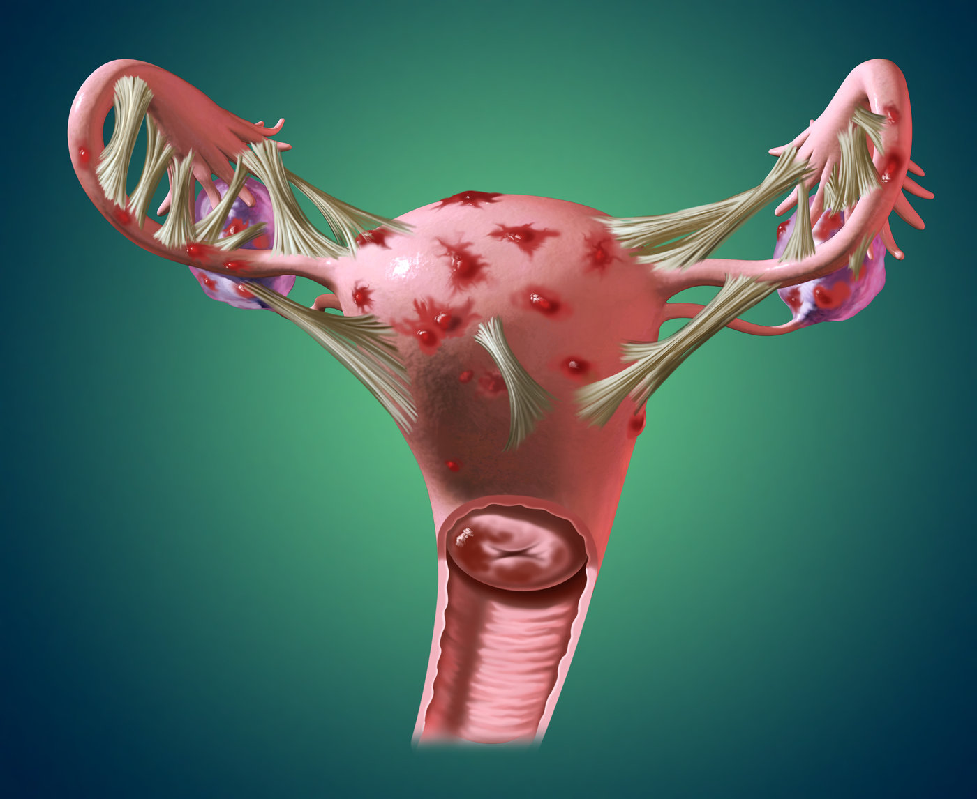 Заболевание матки эндометриоз